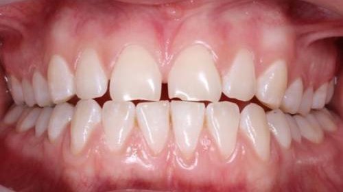 Teeth with gaps between the front two teeth and a visible chip