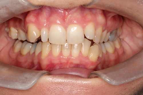 Emily Spence before orthodontic treatment, composite veneer bonding and teeth whitening