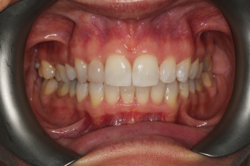 Emily Spence before orthodontic treatment, composite veneer bonding and teeth whitening
