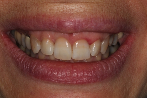 Sara Oates after Invisalign treatment