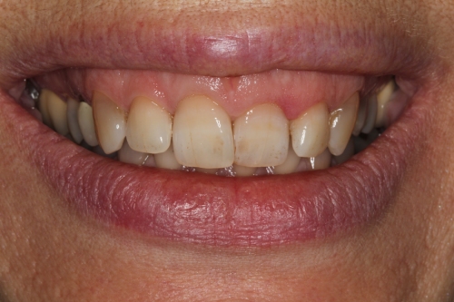 Sara Oates before Invisalign treatment