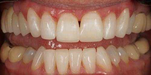 Picture of teeth with smooth and straight edges and a white, clean appearance
