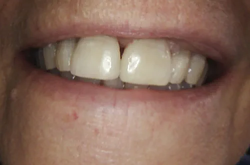 After image shows a fuller smile following composite bonding treatment at Bupa Dental Care Northampton
