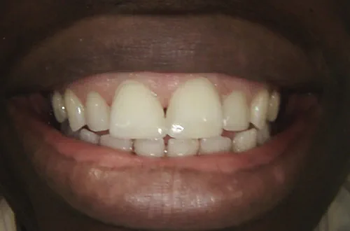 After image shows a straighter, more even smile with less gaps following composite bonding at Bupa Dental Care Northampton