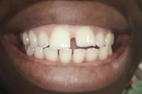 Before image shows an uneven smile with gaps between the front teeth prior to treatment at Bupa Dental Care Northampton