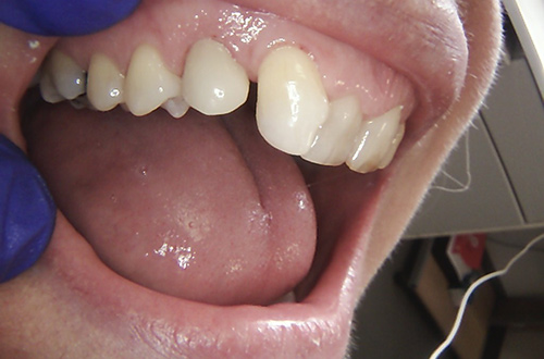 After images shows a fuller, natural coloured smile following composite bonding at Bupa Dental Care Northampton