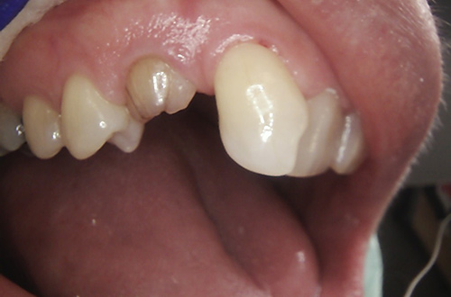 Before image shows a discoloured baby tooth among adult teeth prior to treatment at Bupa Dental Care Northampton