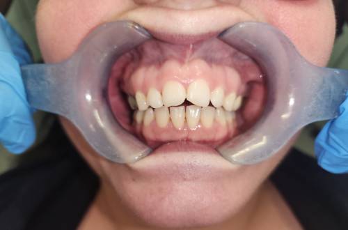 Teeth are seen with lips pulled back so that the different lengths and angled edges of the two front teeth can be seen