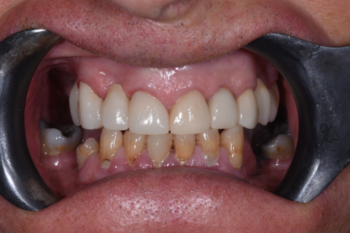 The patient's teeth after having dental implants capped with crowns at Bupa Dental Care Sunderland Wessington
