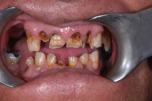 The patient's teeth before having dental implants capped with crowns at Bupa Dental Care Sunderland Wessington