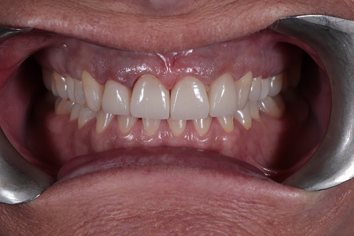 After images show a complete, more even smile following dental crown treatment at Bupa Dental Care Sunderland Wessington