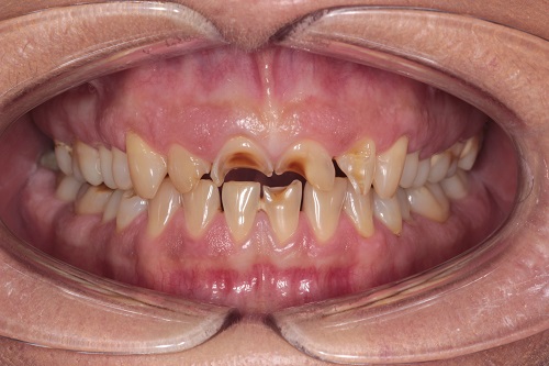 Before image shows missing front teeth prior to treatment at Bupa Dental Care Sunderland Wessington