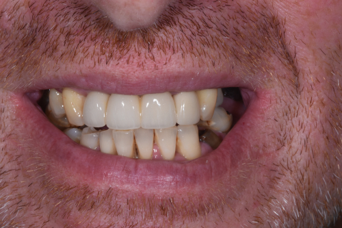 The patient's smile after receiving an implant bridge at Bupa Dental Care Sunderland Wessington