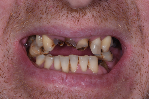 The patient's smile before receiving an implant bridge at Bupa Dental Care Sunderland Wessington
