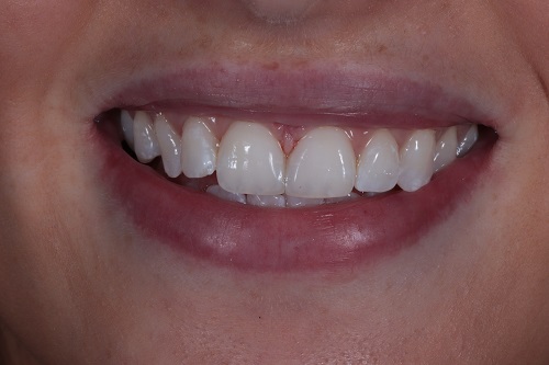 After image shows a fuller, brighter smile after composite bonding and teeth whitening treatment at Bupa Dental Care Wessington