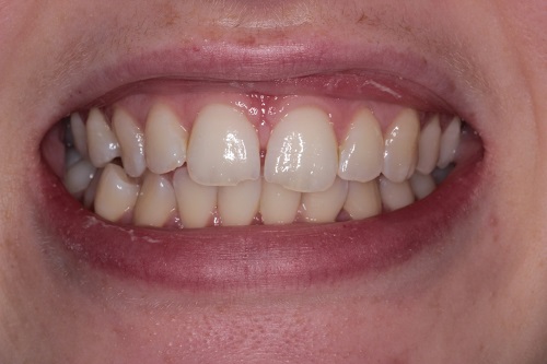 Before image shows a dull smile with small gaps before treatment at Bupa Dental Care Sunderland Wessington