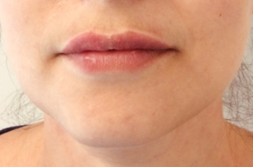 The patients full lips after receiving lip filler treatment