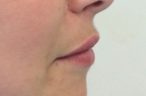 A side profile perspective of the patients lips after receiving lip filler treatment