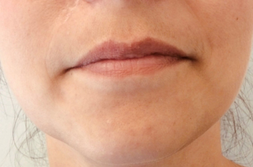 An image of the patients lips before receiving lip filler treatment