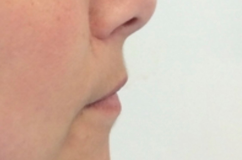 A side profile perspective of the patients lips before receiving lip filler treatment
