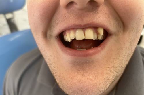 The patient’s two top front teeth are smooth and evenly coloured with a more regular appearance
