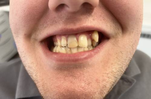 Enamel on the patient’s top front teeth is uneven with discolouration