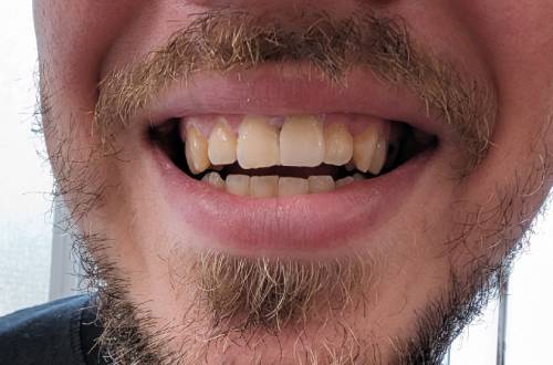 After a new crown is fitted, the patient has perfectly-aligned and straight front teeth