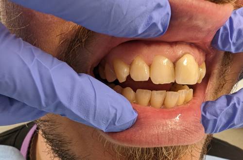One of the patient’s front top teeth sits much further forwards