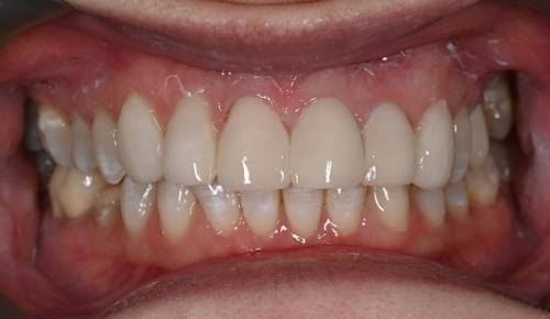 The patient’s teeth have patches of discolouration and uneven edges