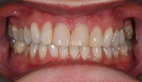 The patient’s teeth have patches of discolouration and uneven edges