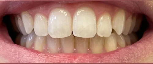 Post teeth whitening treatment the patients natural smile has been restored