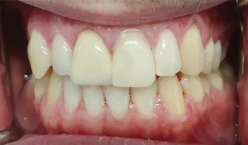 The patients front teeth after receiving a veneer replacement