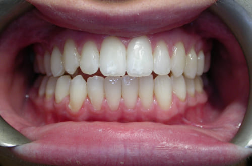 A close-up image of a patient's straight, white smile following Invisalign braces and teeth whitening treatments.