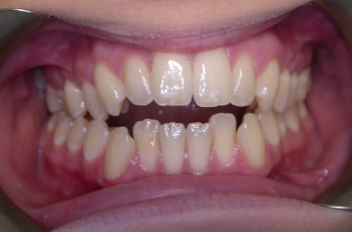 The patients stained and twisted teeth prior to Invisalign aligners and teeth whitening treatment.