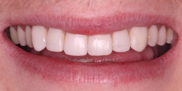 Benefits of Composite Bonding or White Filling - London Specialist Dentists