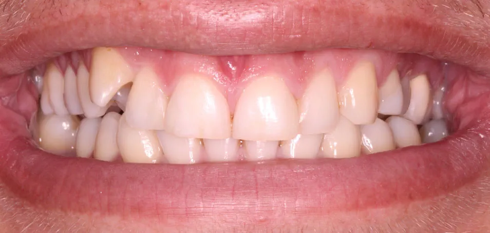 Composite Bonding For Teeth - Dental Treatments