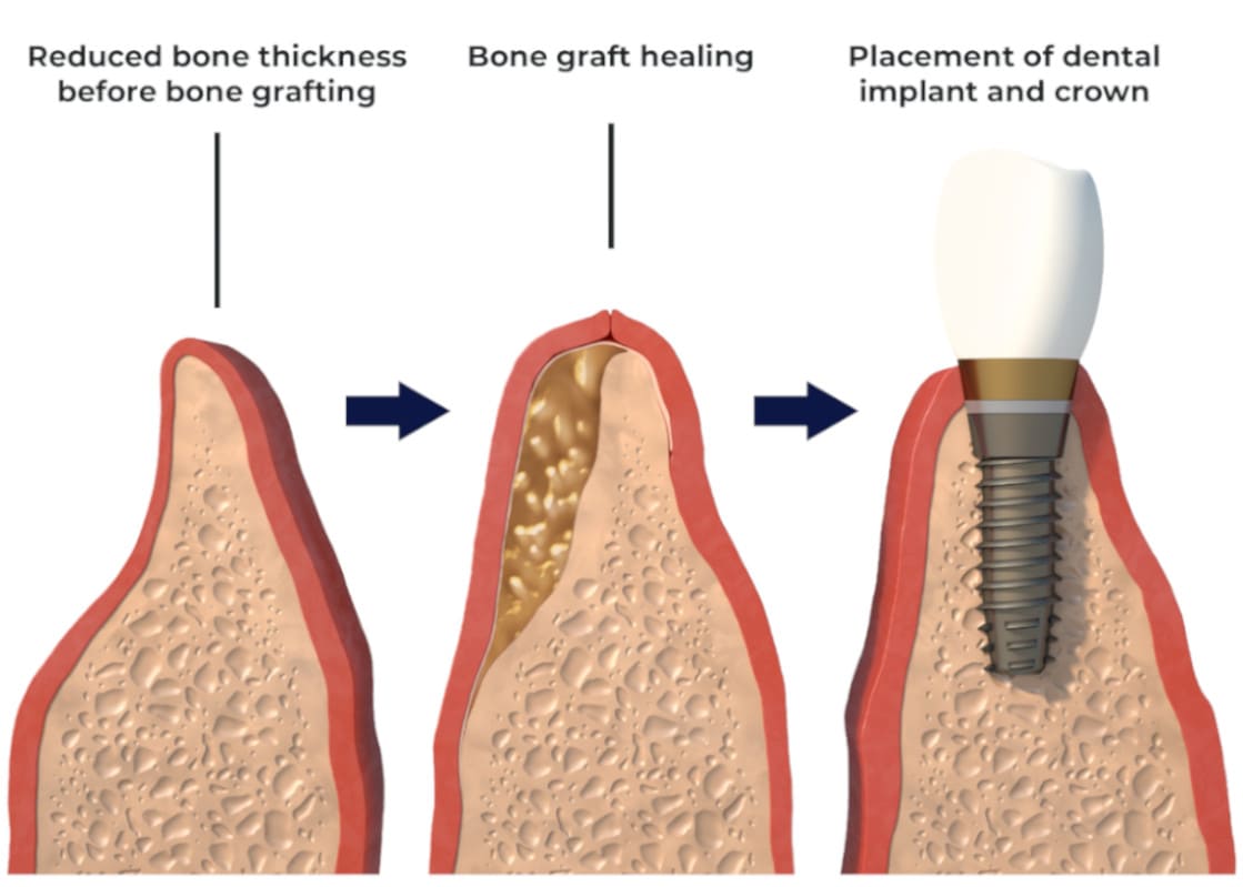 Bone graft section illustration for Bupa dental care