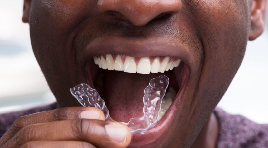 Man smiling putting aligners in