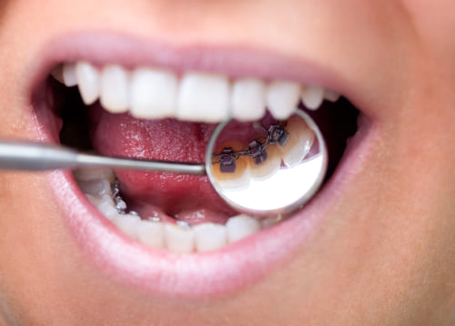 Woman holding mirror in mouth to show metal brace attached to back of teeth