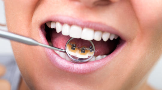 Photo of woman holding magnifying glass in mouth to show metal braces attached to back of teeth
