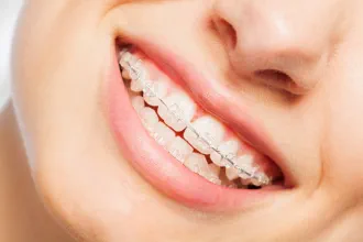 Woman smiling with ceramic clear braces