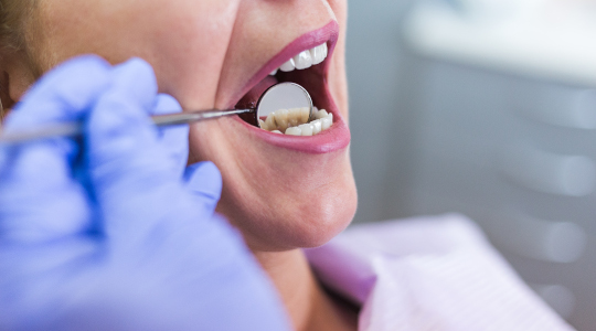 Close up of a patient’s mouth as a dentist uses a small mirror to check for possible causes of tooth sensitivity