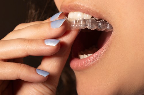 Woman putting in clear aligners