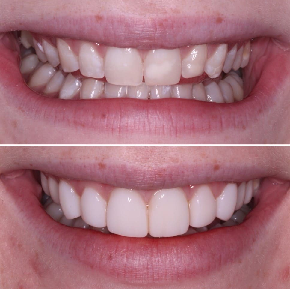 Teeth before and after composite veneers being fitted by Bupa Dental Care.