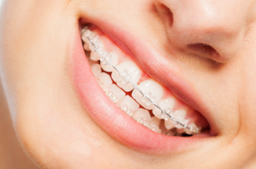 Ceramic brackets  are a clear type of fixed braces.