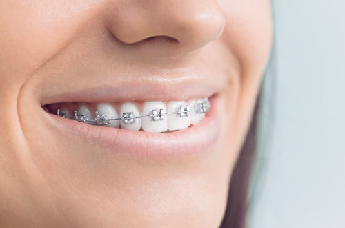 Woman smiling wearing metal braces