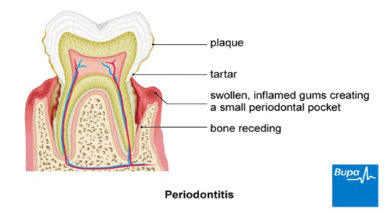 diagram-of-periodontitis