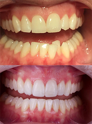 Before and after showing chipped, crooked teeth and straight, healthy smile following Invisalign treatment at Bupa Dental Care.