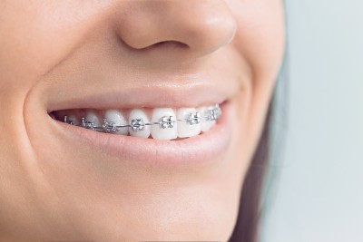 smile with fixed braces
