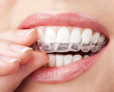 putting on Invisalign aligners